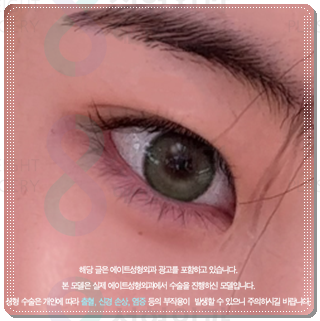 How Much Does Non-Incisional Double-Eyelid Surgery Cost? Comparing Suture and Incisional Methods image 4