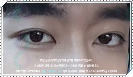 남자 쌍수 비용, 눈매교정 · 앞트임까지 하면 얼마나 달라질까? 관련 이미지 1