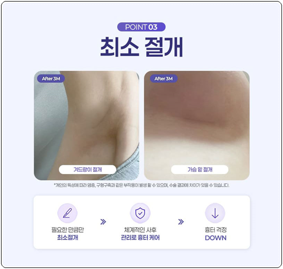 How Much Does Breast Augmentation with Mentor Xtra Cost? What to Know About Feel and Precautions Before and After Surgery image 14