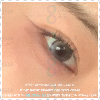 What Are the Prices and Combined Effects of Epicanthoplasty and Upper Epicanthoplasty with Double Eyelid Surgery? From Eye Shape Changes in Reviews of Front-and-Upper Epicanthoplasty to the Differences image 4