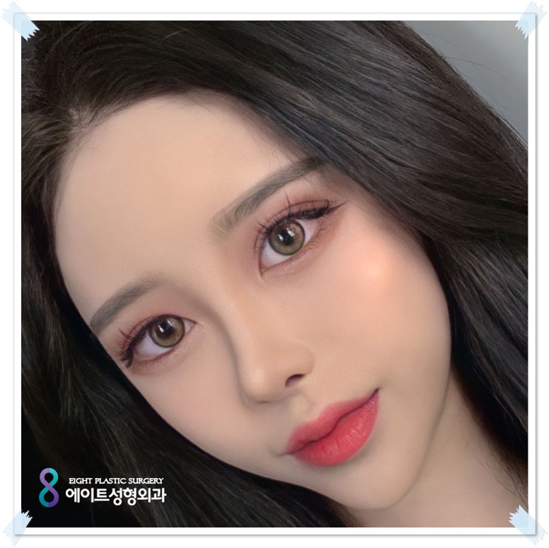 Which Eyes Need a Difference Before and After Epicanthoplasty? image 2