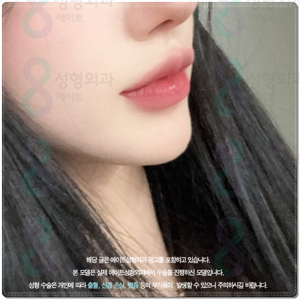 울쎄라 턱살에 효과 언제부터 있나요? (300샷 기준의 가격 평균은?) 관련 이미지 3