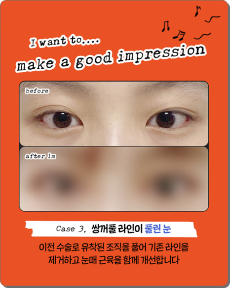 실패 없는 쌍꺼풀 재수술을 위해: 매몰법 특징부터 비용, 시기별 붓기 회복 과정 관련 이미지 13