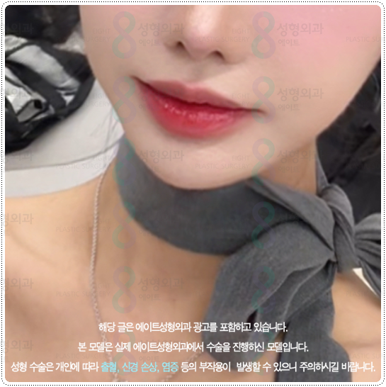 What Is the Difference Between 100 Shots and 300 Shots of Ulthera? Let’s Also Look at Ultherapy Prime Pricing and When Lifting Effects Appear image 4