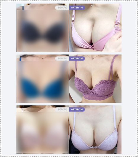 가슴 절벽 걱정? 가슴확대 수술 비용과 촉감, 후기 만족에 대해서 (멘토 스무스) 관련 이미지 12