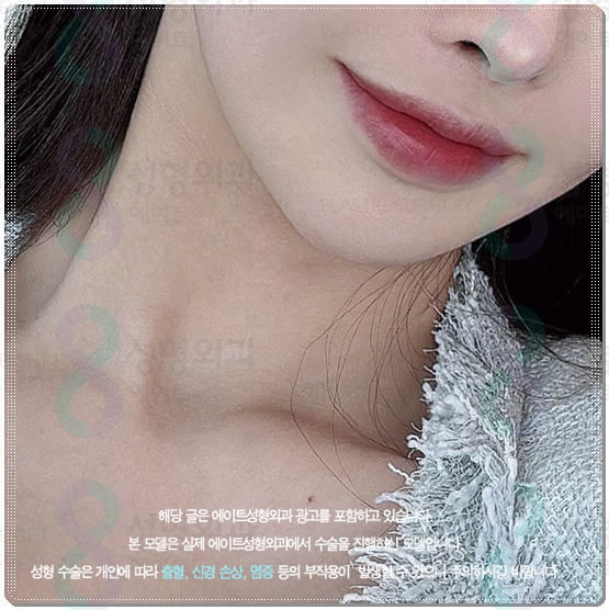 Gangnam) How Much Does 300 Shots of Ultherapy Cost? Treatment Time, Frequency, and Before-and-After Results (Ultherapy PRIME) image 4