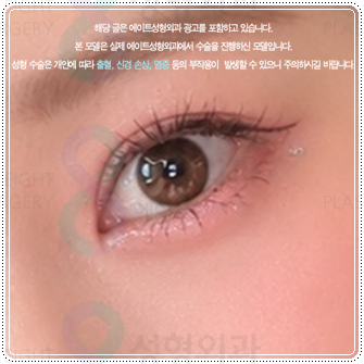 Preparing for the Cost and Swelling When Combining Medial and Lateral Canthoplasty with Double-Eyelid Surgery: A Comparison image 5