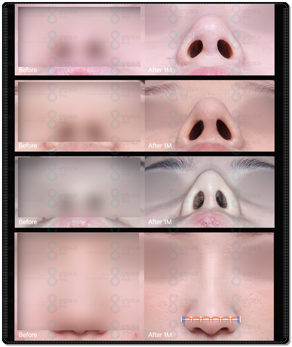 Bokko Rhinoplasty Review Summary! In Sinsa-dong, what are the costs of bokko surgery and the criteria for choosing a good clinic? image 20