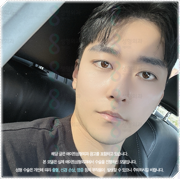 남자 코성형 종류 어떤 게 맞을까? 평균 비용부터 회복기간, 발품 팁까지 완벽 가이드 관련 이미지 5