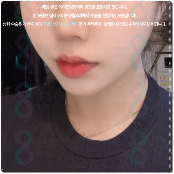 피부과 추천 정보? 울쎄라 강남 어디가 잘하는곳인가요? 수면마취, 가격 부담없이 하는법 관련 이미지 4