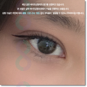 쌍수 가격은 평균적으로 얼마일까요? 매몰과 비절개? 절개 차이점까지 관련 이미지 1