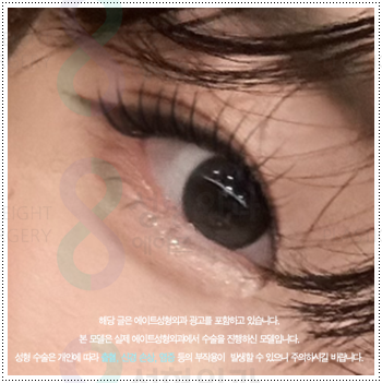 쌍꺼풀 자연유착과 매몰, 절개 사이에서 고민이라면? 비용과 풀림 가능성을 낮추는 수술 방법은? 관련 이미지 3