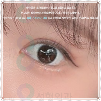 Preparing for the Cost and Swelling When Combining Medial and Lateral Canthoplasty with Double-Eyelid Surgery: A Comparison image 4