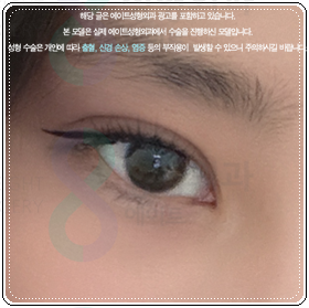 쌍꺼풀 아웃라인? 인라인? 수술 고민, 자연유착과 절개의 비용 차이는? 관련 이미지 6