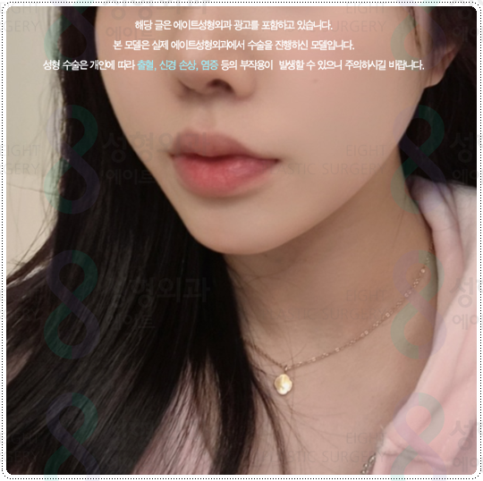 Ultherapy Lifting with 300 Shots: What Are the Price and Before-and-After Changes You Should Know Before the Procedure? image 5