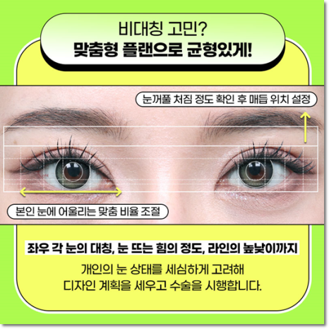 쌍수 가격은 평균적으로 얼마일까요? 매몰과 비절개? 절개 차이점까지 관련 이미지 12