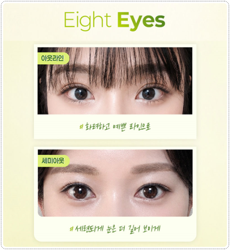 Natural Double Eyelid Surgery Using the Non-Incisional Method: A Budget and Consultation Guide for Middle School Students’ Eye Shapes Before and After Surgery image 10