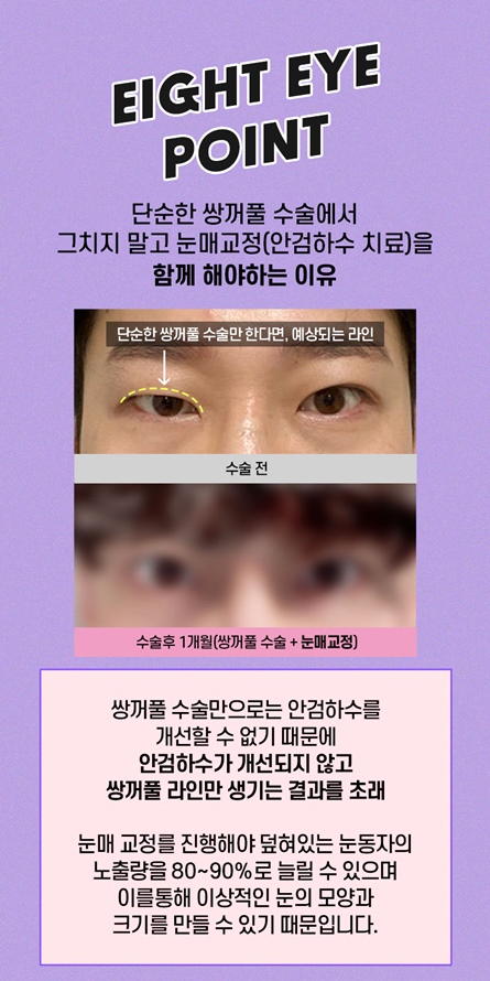 강남 눈매교정잘하는곳 비절개눈매교정전후 가격 차이에 대해서 관련 이미지 8