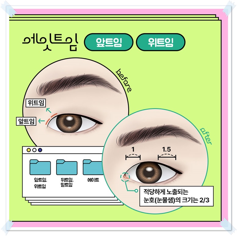 Which Eyes Need a Difference Before and After Epicanthoplasty? image 4