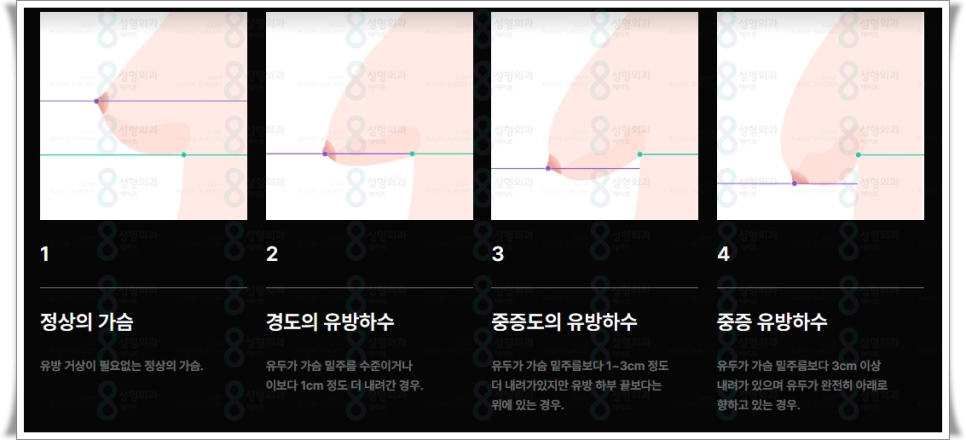 처진가슴수술 방법은? 가슴성형 보형물 선택과 멘토부스트 후기 특징 정리 관련 이미지 8