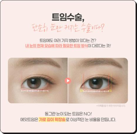 앞트임을 고민할 때, 눈매에 따라 달라지는 선택 관련 이미지 2
