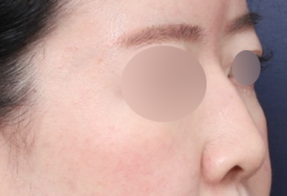 A Real Sinsa Station Rhinoplasty Case That Created a Harmonious Face image 2