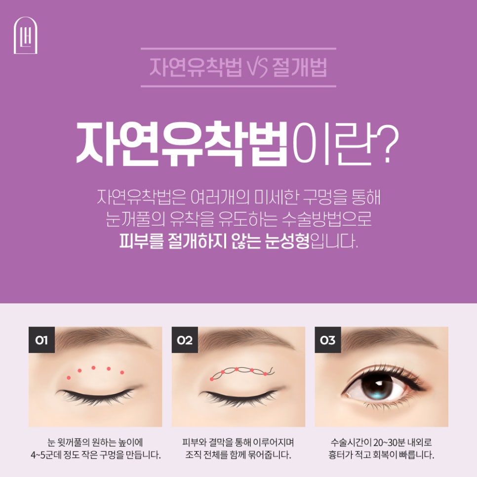 비절개쌍수 절개법과 다르점은 관련 이미지 2