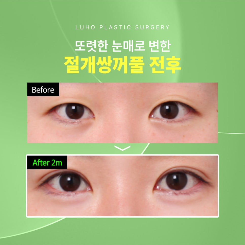 A Case of Eye Surgery Near Sinsa Station: Changed to a Natural and Defined Look image 1