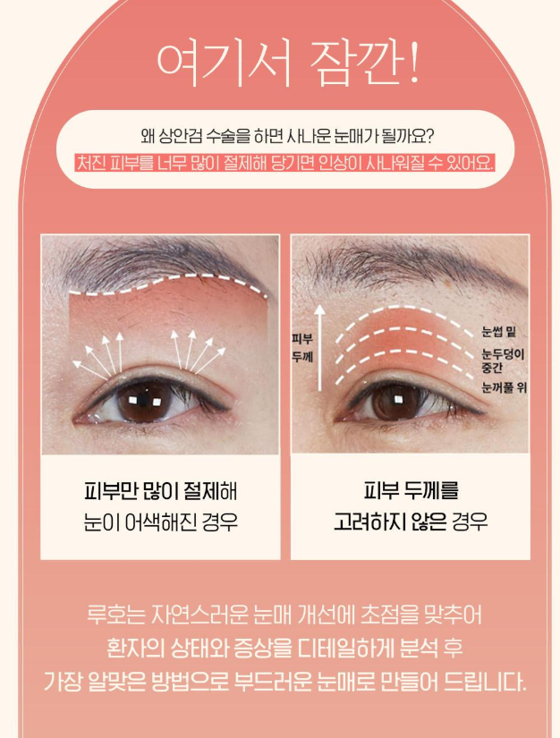 Sinsa Station Lower Eyelid Surgery Clinic: Real Before-and-After Comparison image 4