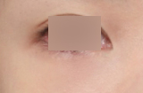 A Review of Medial Epicanthoplasty Revision That Restored a Natural Look to the Inner Corners of the Eyes image 5
