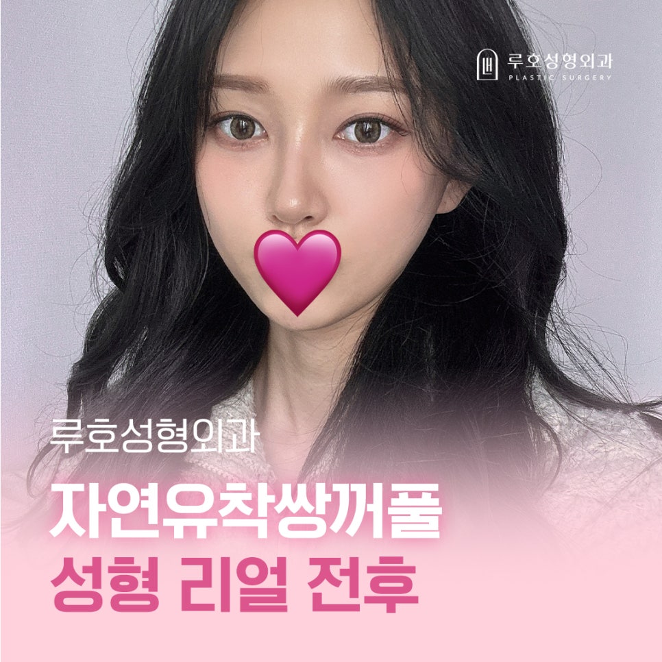 압구정 자연유착쌍꺼풀 리얼 후기 관련 이미지 5