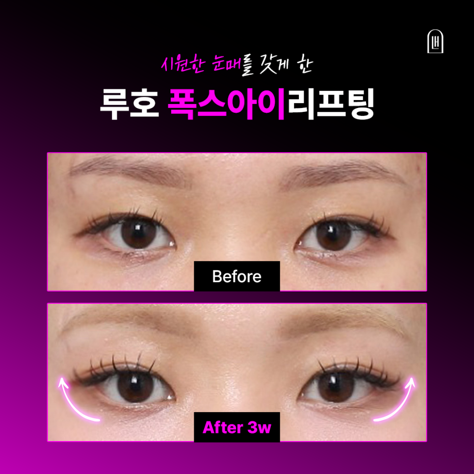 A More Open, Face-Appropriate Eye Shape After Outer-Corner Thread Lifting image 1