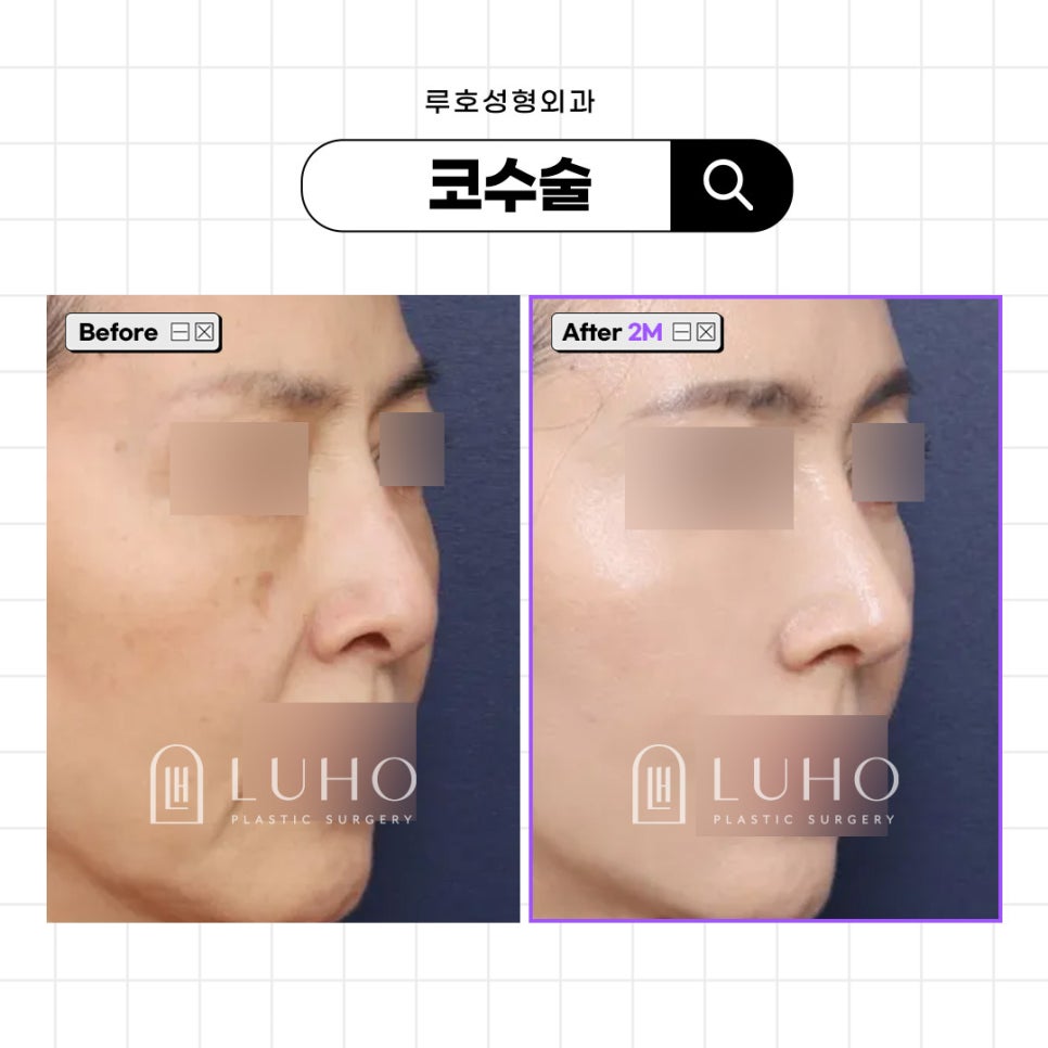 신사역 긴코성형, 입체감 있는 라인을 위해 관련 이미지 1