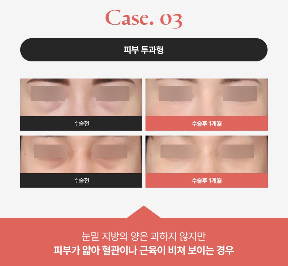 How to Get Rid of Dark Circles: A Look at Under-Eye Fat Repositioning Reviews Near Sinsa Station image 4