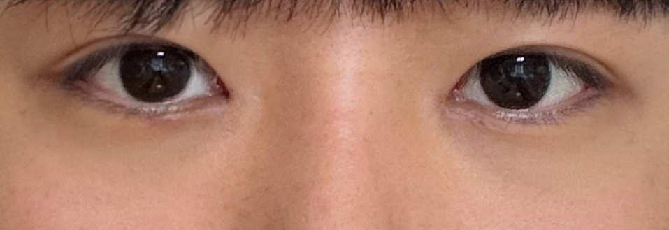 Review of Male Eye Surgery at Sinnonhyeon Station: Finding the Eye Shape That Suits Me image 5