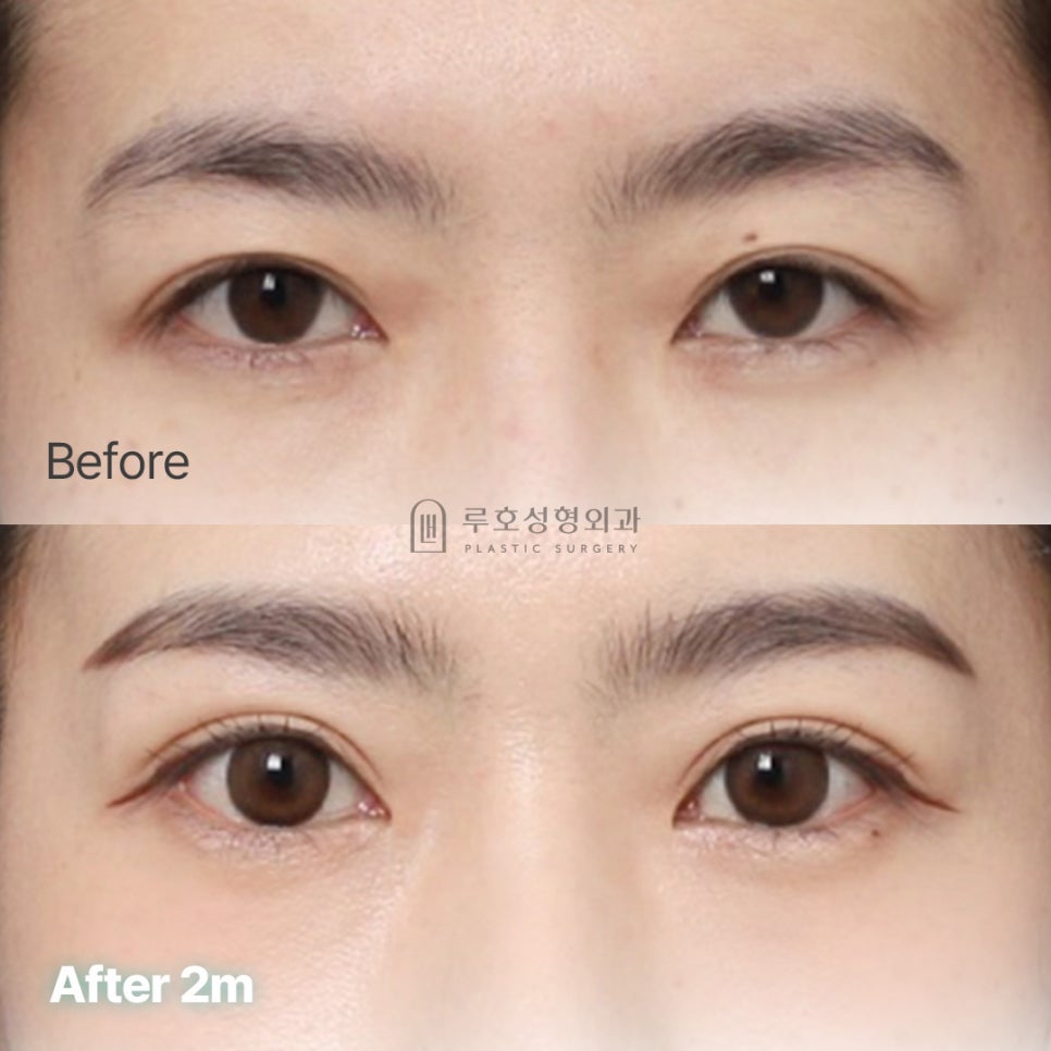 Could a Tired-Looking Appearance Change with a Forehead Lift in Gangnam at Sinsa Station? image 1