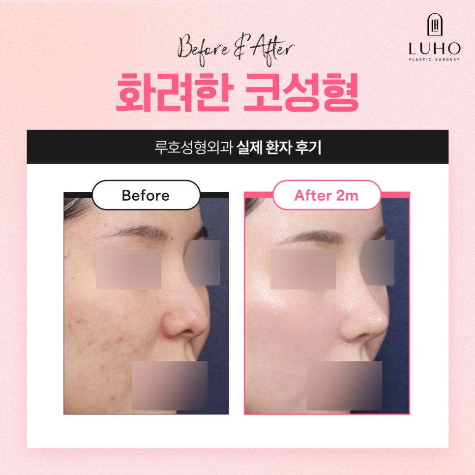 A Real Review of Nose Surgery at Luho Plastic Surgery, Customized to Fit My Face image 3