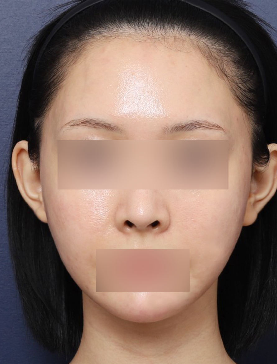 이중 턱살 제거한 신사역 펠리컨 수술 전후 관련 이미지 5