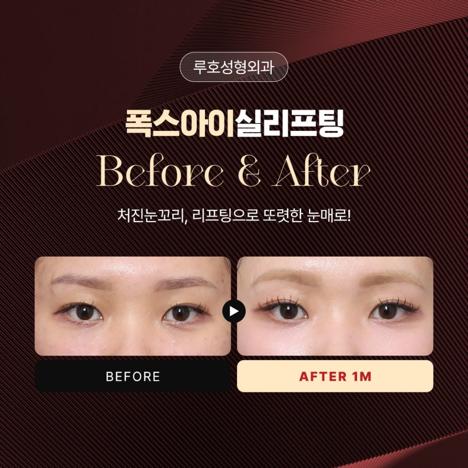 신사역 폭스아이실리프팅으로 처진 눈꼬리를 교정한 사례 관련 이미지 1