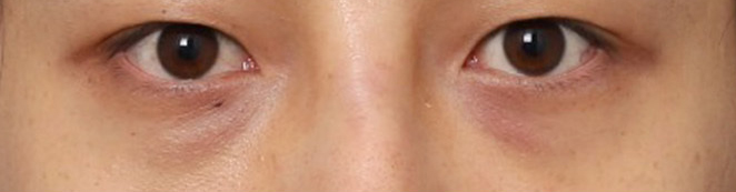 Men’s Eye Surgery at Sinsa Station: A Case of Correcting a Heavy-Looking Eye Shape image 5
