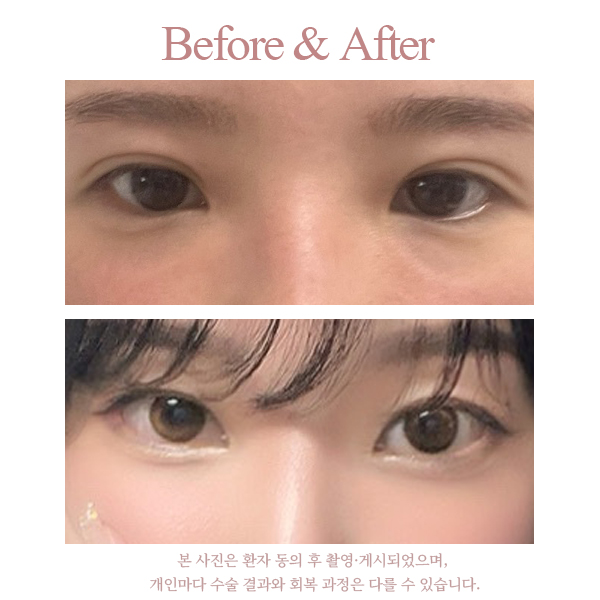 A Review of Shinsegae Station Under-Eye Fat Repositioning to Improve Dark Shadows Under the Eyes image 5