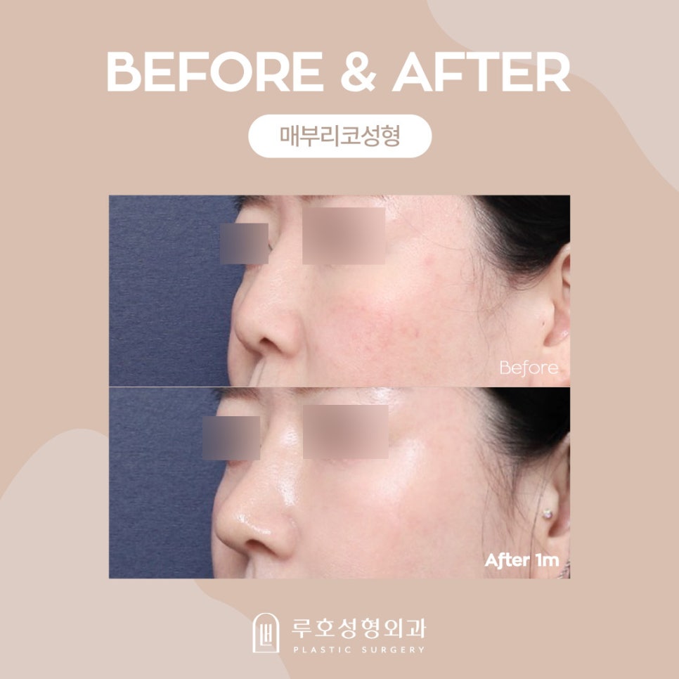Hump Nose Surgery: Why Is It Needed? image 2