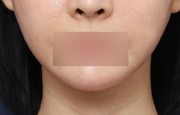 Pelican Surgery: A Method for Smoothing a Blunt Jawline image 5