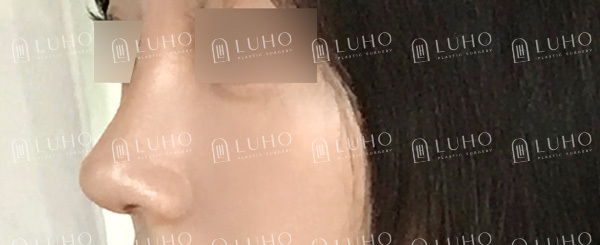 Before and After Gangnam Rhinoplasty for a Hump Nose: Refining the Prominent Hump for a New Look image 8
