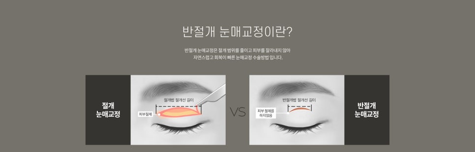 눈 수술법의 종류와 회복기간 #1 관련 이미지 6