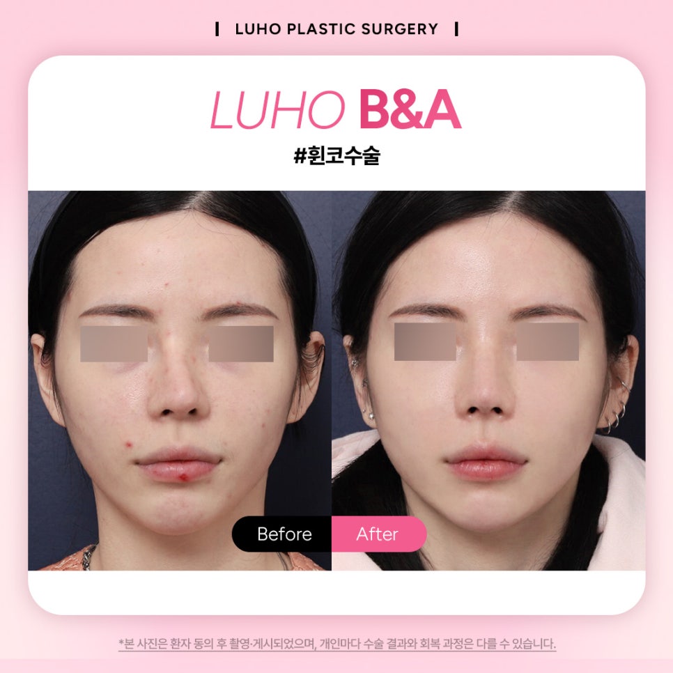휘어진 코를 바르게 신사역 휜코수술 후기 관련 이미지 1