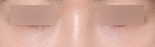 A Review of Under-Eye Surgery Near Sinsa Station That Changed My Shadowed Impression Caused by Dark Circles image 5