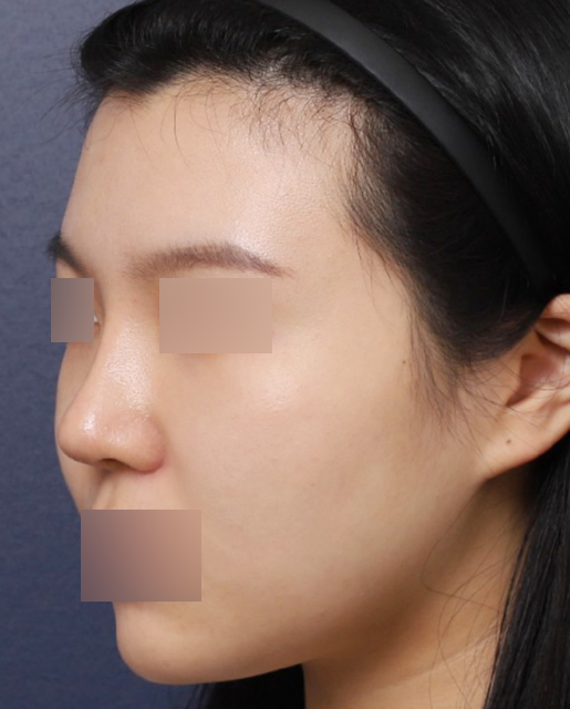 신사역 복코 재수술 전후 : 얄쌍한 콧대로 바뀐 사례 관련 이미지 4