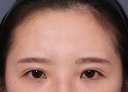 A Brighter Impression with an Endoscopic Forehead Lift to Correct Drooping Eyebrows image 4