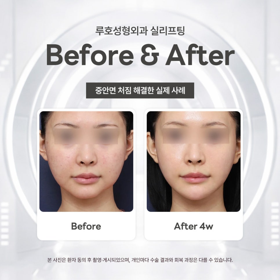 중안면 처짐 사라진 신사역 실리프팅 전후 알아보기 관련 이미지 1
